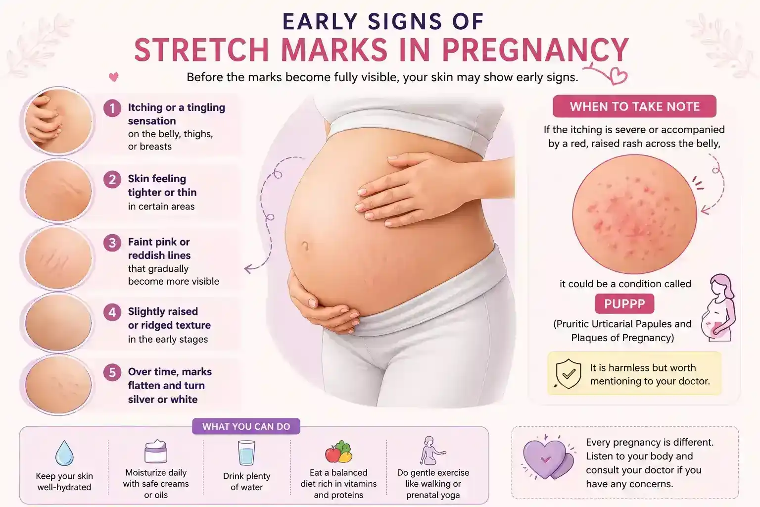 Pregnancy belly with visible Stretch Marks in Pregnancy